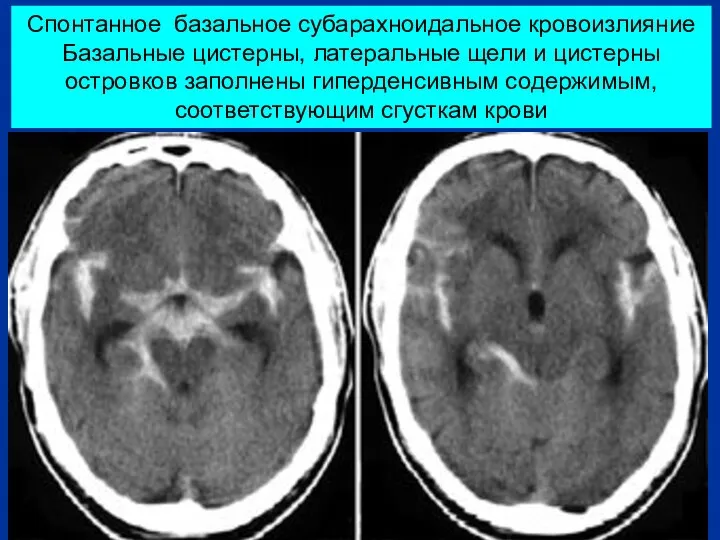 Спонтанное базальное субарахноидальное кровоизлияние Базальные цистерны, латеральные щели и цистерны островков