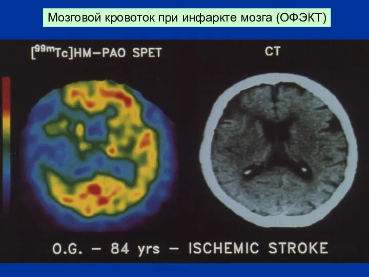 Мозговой кровоток при инфаркте мозга (ОФЭКТ)