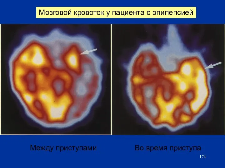 Мозговой кровоток у пациента с эпилепсией Между приступами Во время приступа
