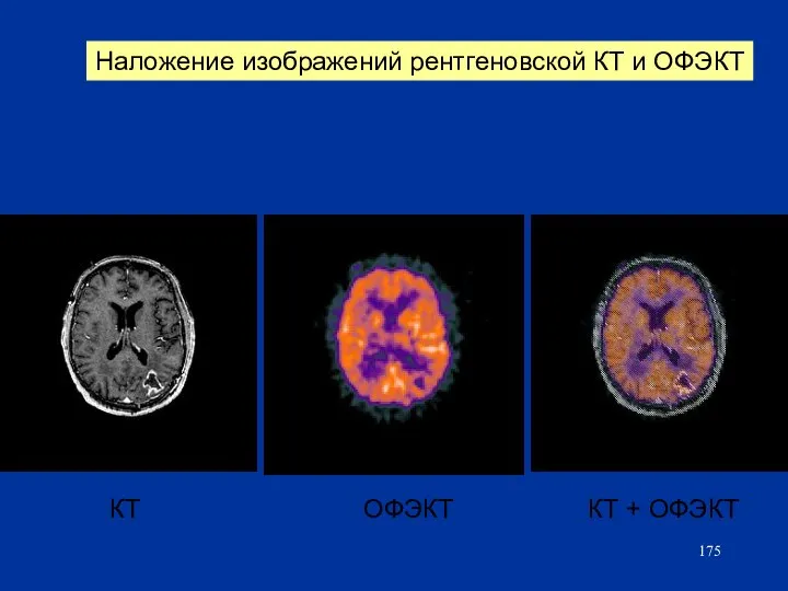 КТ ОФЭКТ КТ + ОФЭКТ Наложение изображений рентгеновской КТ и ОФЭКТ