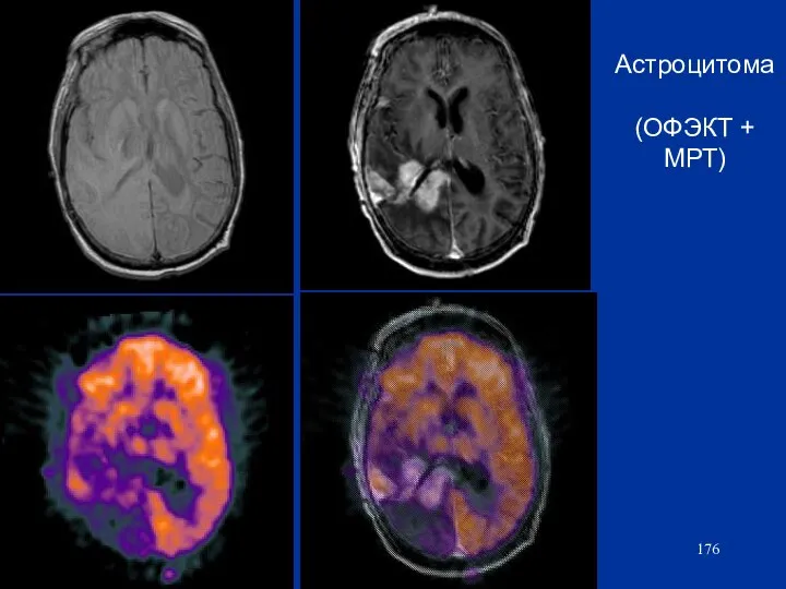 Астроцитома (ОФЭКТ + МРТ)