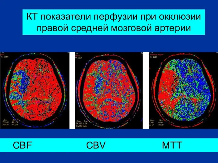 КТ показатели перфузии при окклюзии правой средней мозговой артерии CBF CBV MTT