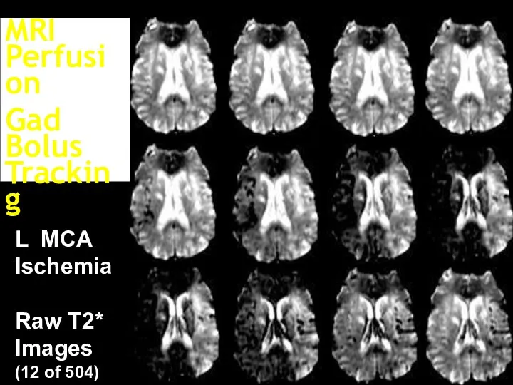 L MCA Ischemia Raw T2* Images (12 of 504) MRI Perfusion Gad Bolus Tracking