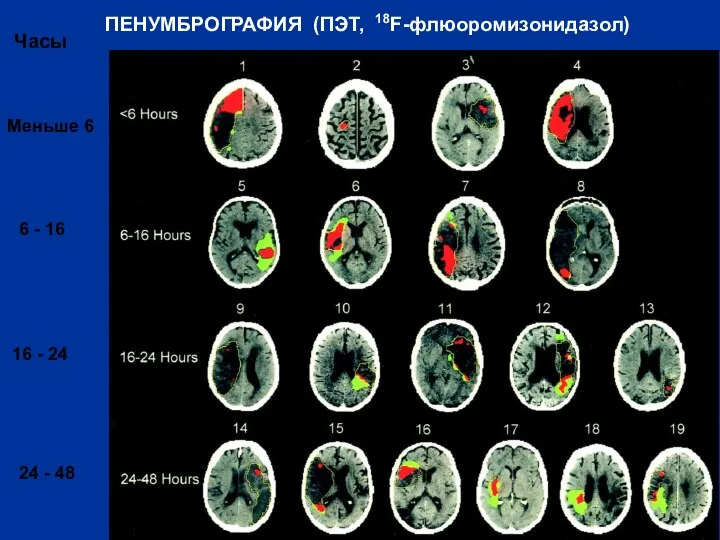 ПЕНУМБРОГРАФИЯ (ПЭТ, 18F-флюоромизонидазол) Часы Меньше 6 6 - 16 16 - 24 24 - 48