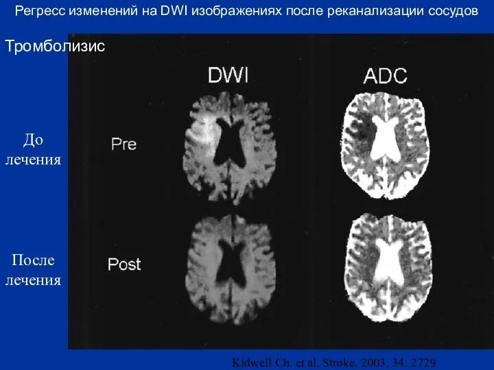 Регресс изменений на DWI изображениях после реканализации сосудов Тромболизис До лечения