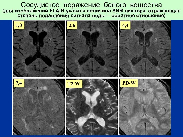 Сосудистое поражение белого вещества (для изображений FLAIR указана величина SNR ликвора,