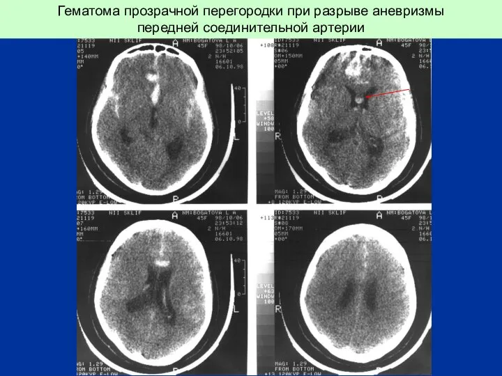 Гематома прозрачной перегородки при разрыве аневризмы передней соединительной артерии