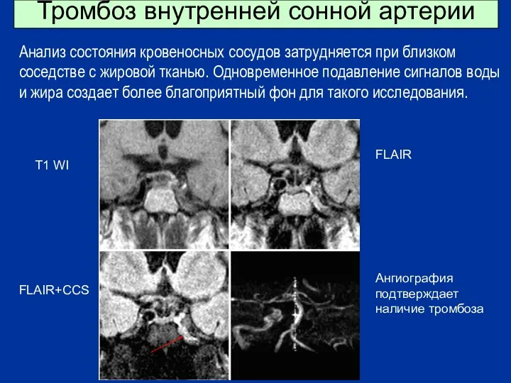 Тромбоз внутренней сонной артерии T1 WI FLAIR FLAIR+ССS Ангиография подтверждает наличие