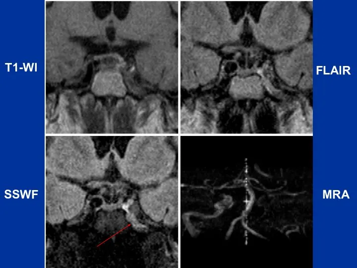 T1-WI FLAIR SSWF MRA