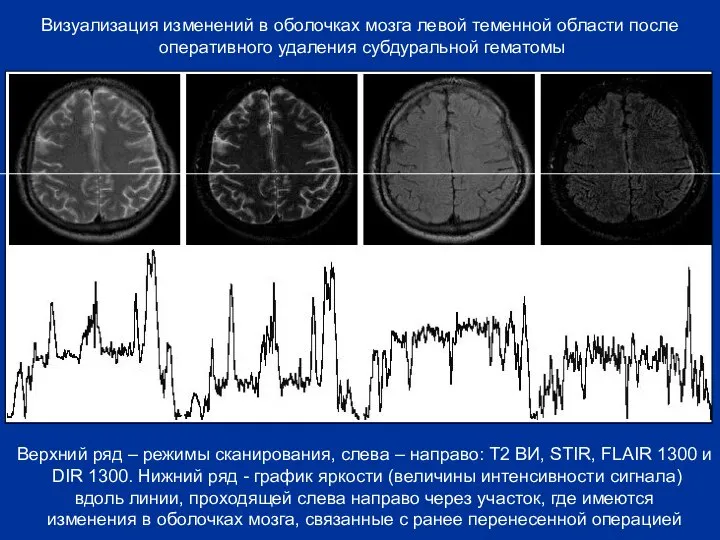 Визуализация изменений в оболочках мозга левой теменной области после оперативного удаления