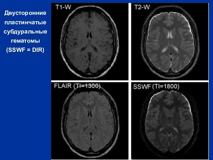 Двусторонние пластинчатые субдуральные гематомы (SSWF = DIR)