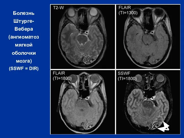 Болезнь Штурге- Вебера (ангиоматоз мягкой оболочки мозга) (SSWF = DIR)