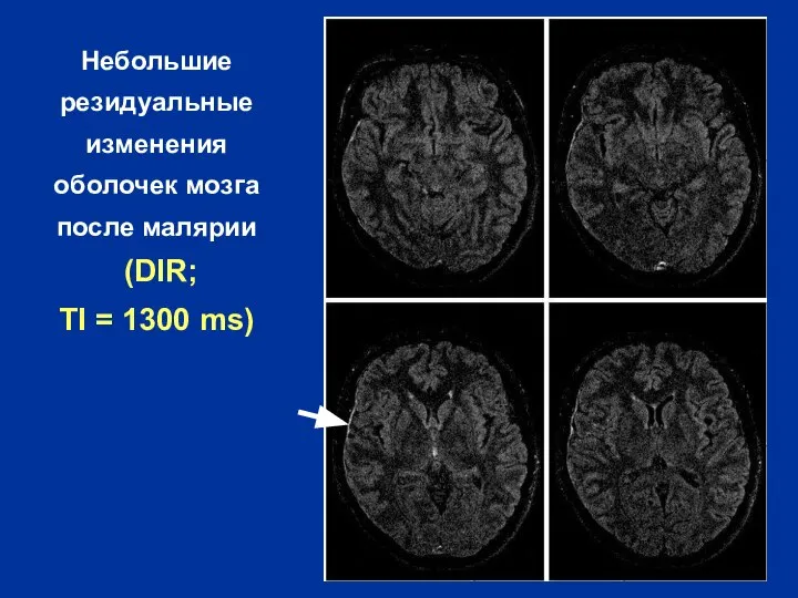 Небольшие резидуальные изменения оболочек мозга после малярии (DIR; TI = 1300 ms)