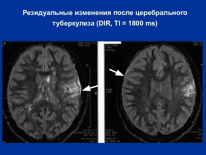 Резидуальные изменения после церебрального туберкулеза (DIR, TI = 1800 ms)