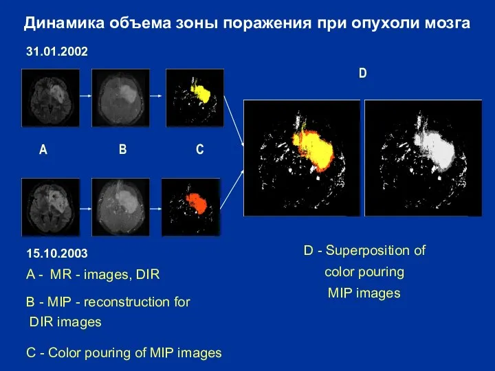 31.01.2002 A - МR - images, DIR B - MIP -