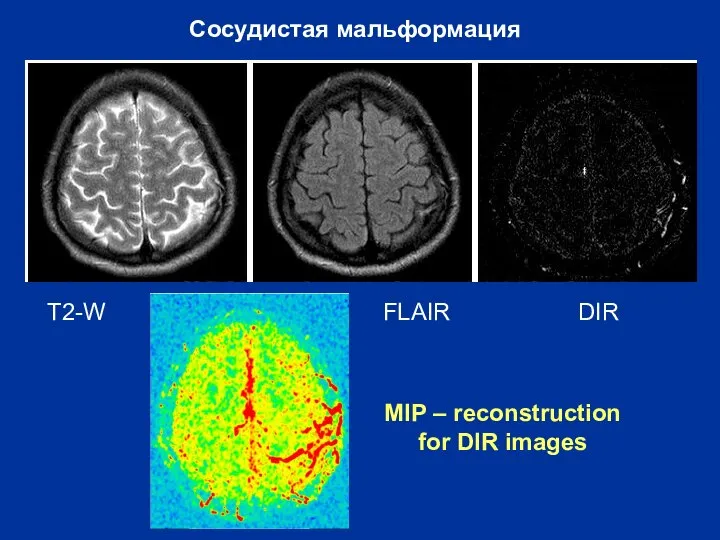 T2WI FLAIR FLAIR+STIR Сосудистая мальформация T2-W FLAIR DIR MIP – reconstruction for DIR images