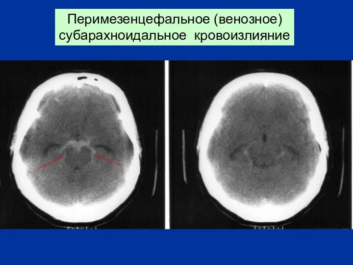 Перимезенцефальное (венозное) субарахноидальное кровоизлияние