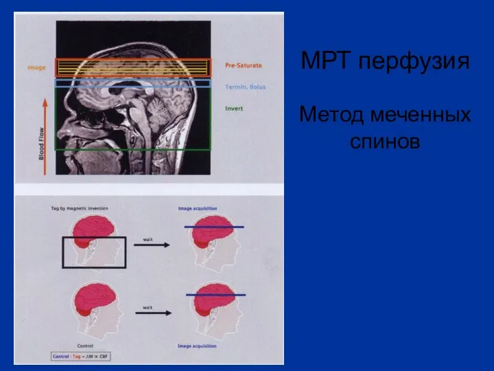 МРТ перфузия Метод меченных спинов