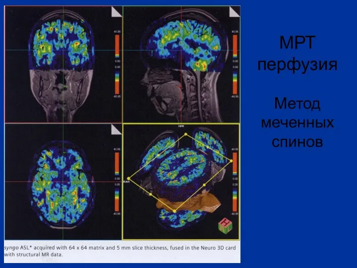 МРТ перфузия Метод меченных спинов