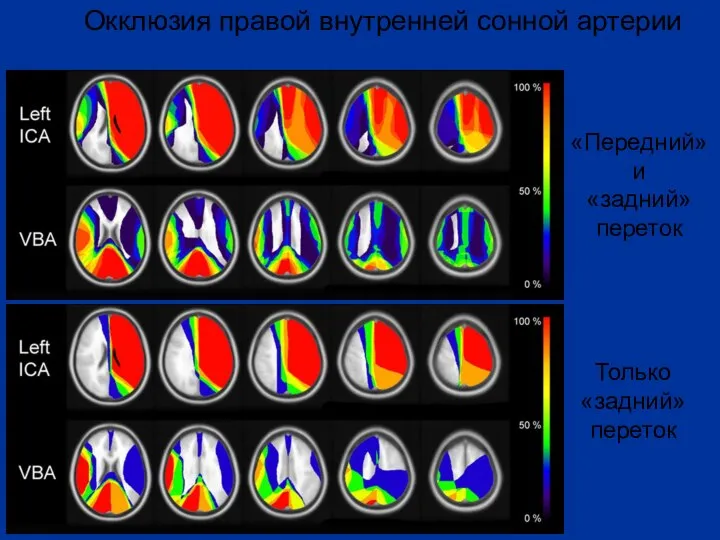 Окклюзия правой внутренней сонной артерии «Передний» и «задний» переток Только «задний» переток