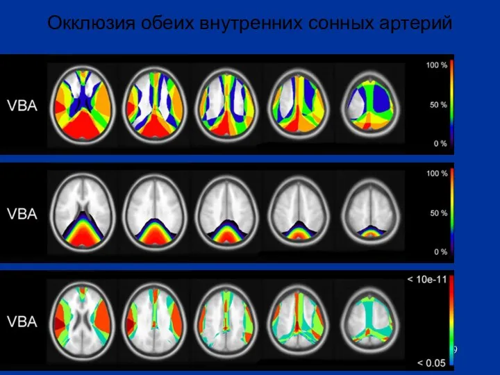 Окклюзия обеих внутренних сонных артерий