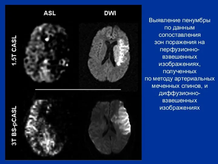 Выявление пенумбры по данным сопоставления зон поражения на перфузионно-взвешенных изображениях, полученных