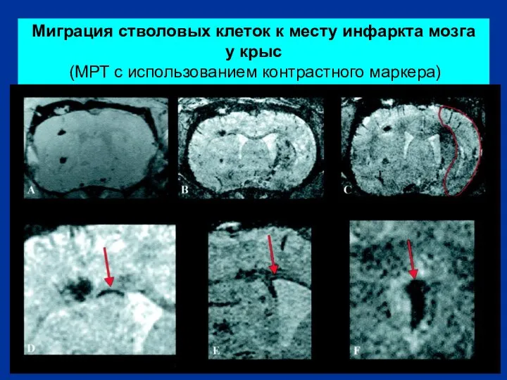 Миграция стволовых клеток к месту инфаркта мозга у крыс (МРТ с использованием контрастного маркера)