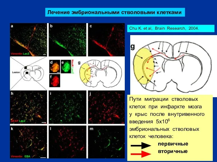 Лечение эмбриональными стволовыми клетками Пути миграции стволовых клеток при инфаркте мозга