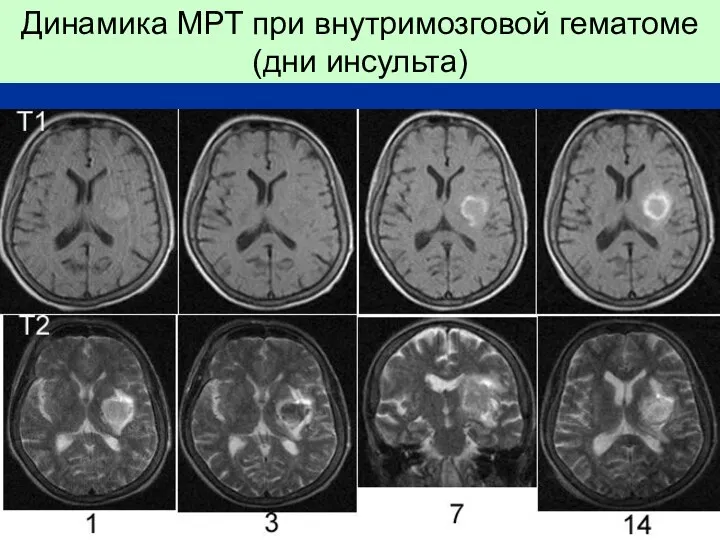 Динамика МРТ при внутримозговой гематоме (дни инсульта)