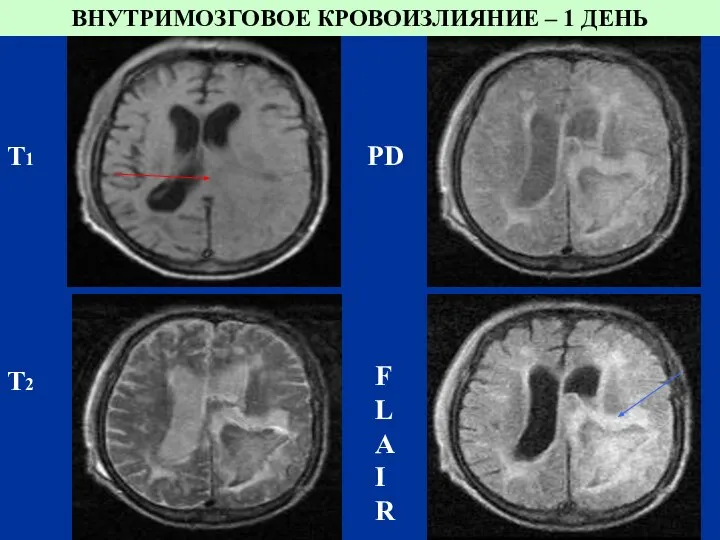 FLAIR Т1 PD Т2 ВНУТРИМОЗГОВОЕ КРОВОИЗЛИЯНИЕ – 1 ДЕНЬ