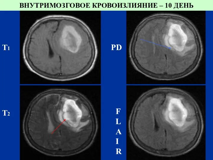 Т1 PD Т2 FLAIR ВНУТРИМОЗГОВОЕ КРОВОИЗЛИЯНИЕ – 10 ДЕНЬ