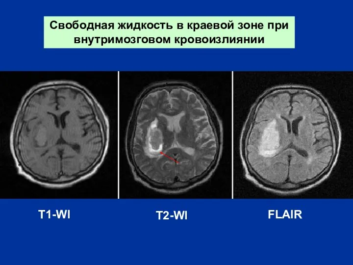 Свободная жидкость в краевой зоне при внутримозговом кровоизлиянии T1-WI T2-WI FLAIR