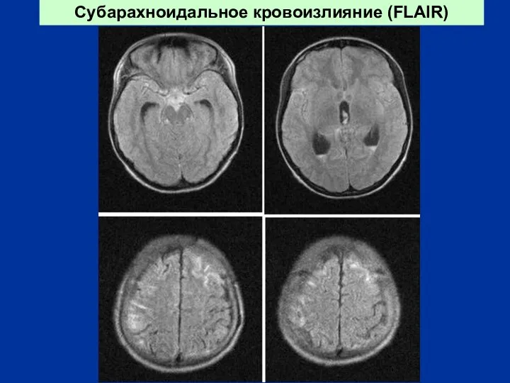 Субарахноидальное кровоизлияние (FLAIR)