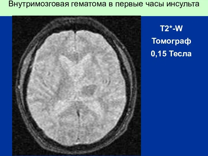 Внутримозговая гематома в первые часы инсульта T2*-W Томограф 0,15 Тесла