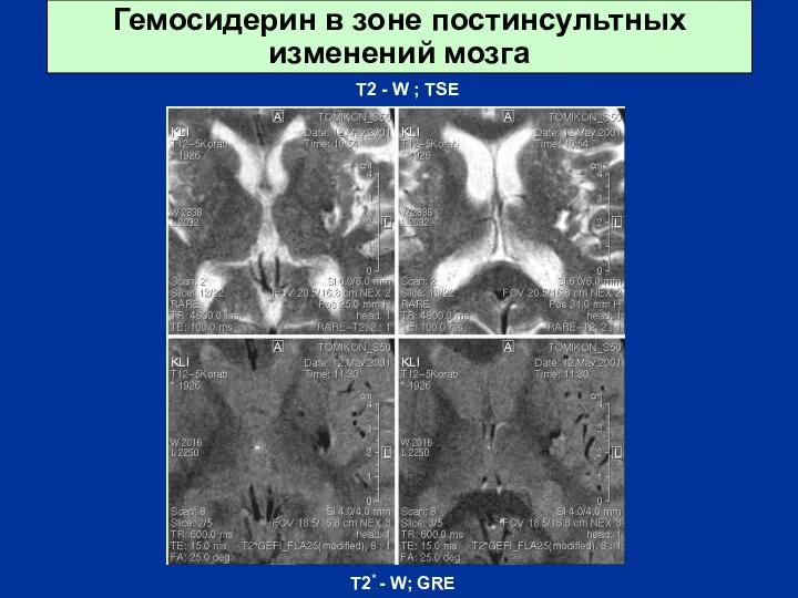 Гемосидерин в зоне постинсультных изменений мозга T2 - W ; TSE T2* - W; GRE