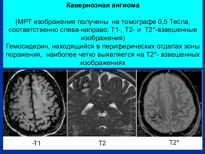 Кавернозная ангиома (МРТ изображения получены на томографе 0,5 Тесла, соответственно слева-направо: