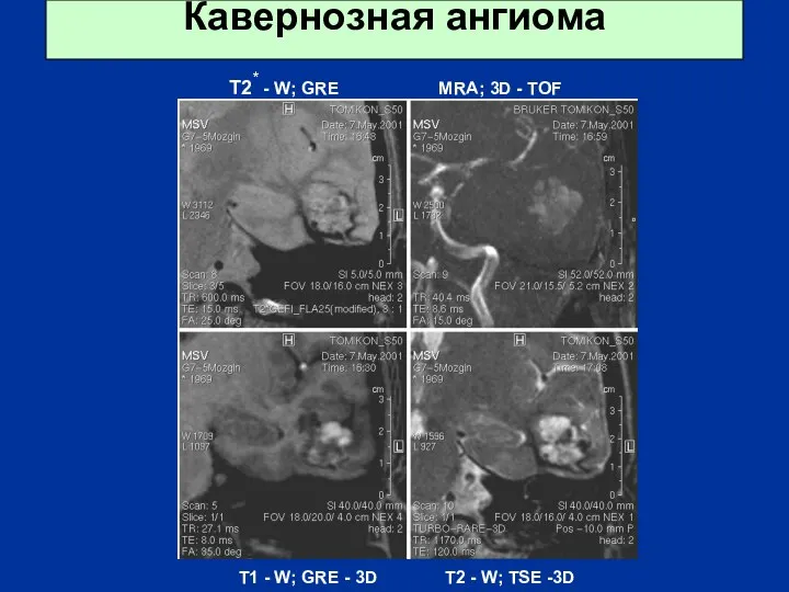 Кавернозная ангиома T2* - W; GRE MRA; 3D - TOF T1