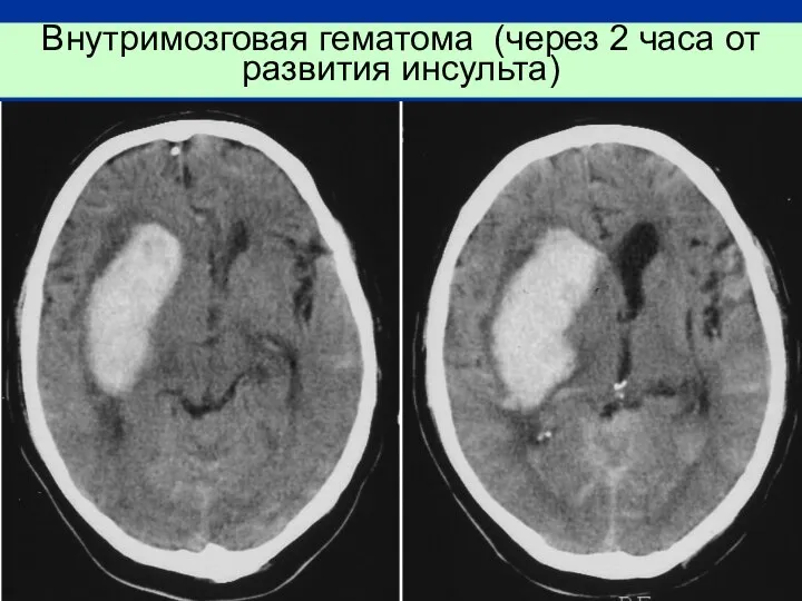 Внутримозговая гематома (через 2 часа от развития инсульта)