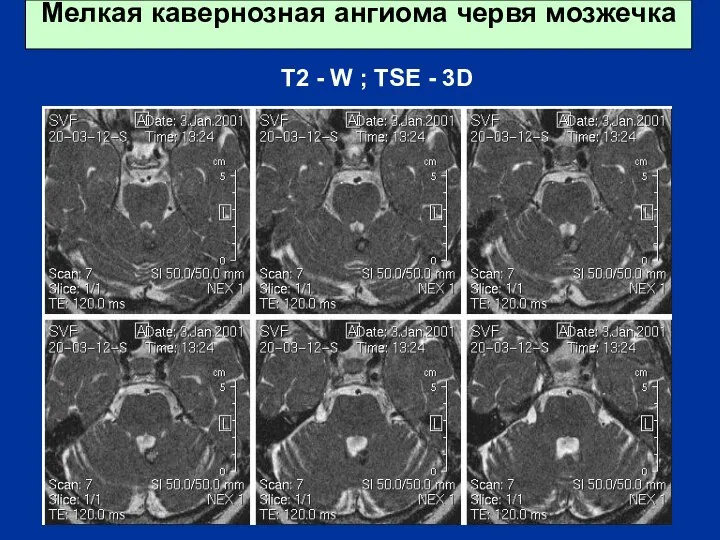 Мелкая кавернозная ангиома червя мозжечка T2 - W ; TSE - 3D