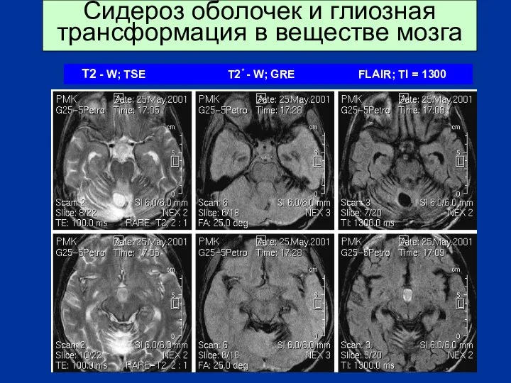 Сидероз оболочек и глиозная трансформация в веществе мозга T2 - W;