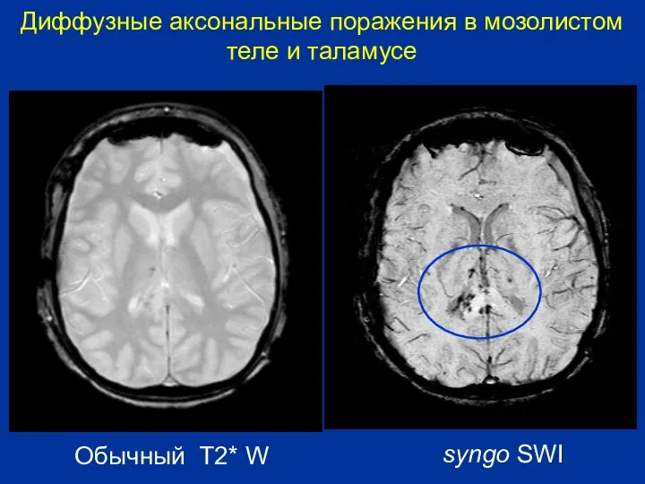 Обычный T2* W Диффузные аксональные поражения в мозолистом теле и таламусе