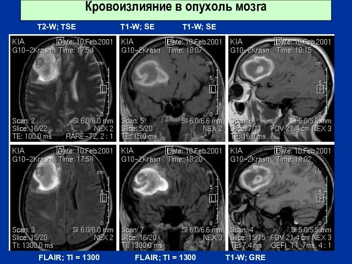 Кровоизлияние в опухоль мозга T2-W; TSE T1-W; SE T1-W; SE FLAIR;