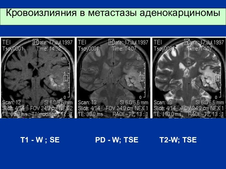 Кровоизлияния в метастазы аденокарциномы T1 - W ; SE PD - W; TSE T2-W; TSE