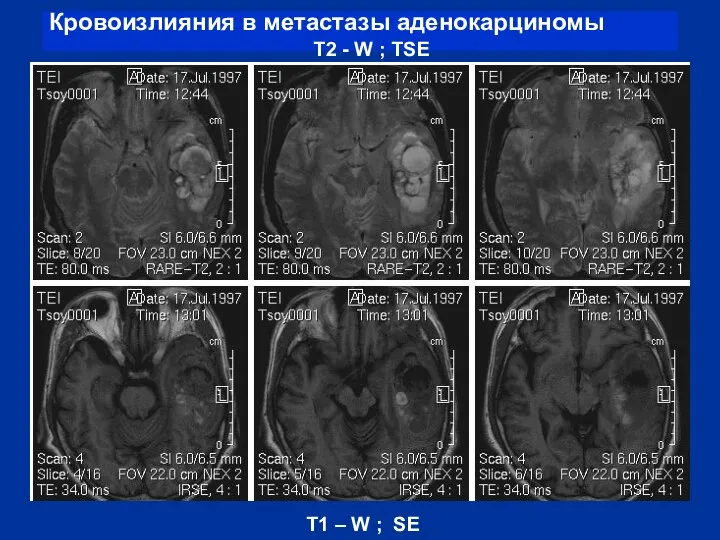 Кровоизлияния в метастазы аденокарциномы T2 - W ; TSE T1 – W ; SE