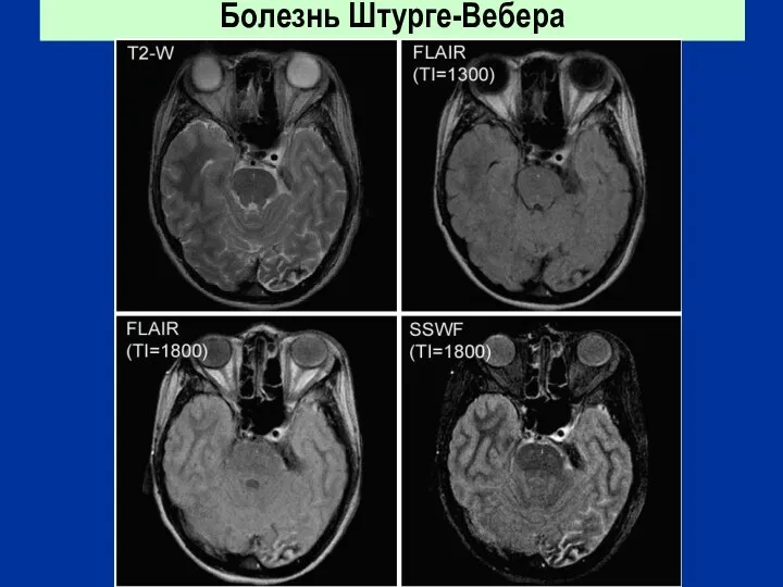 Болезнь Штурге-Вебера