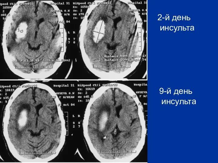 2-й день инсульта 9-й день инсульта