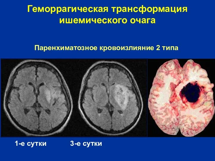 1-е сутки 3-е сутки Геморрагическая трансформация ишемического очага Паренхиматозное кровоизлияние 2 типа