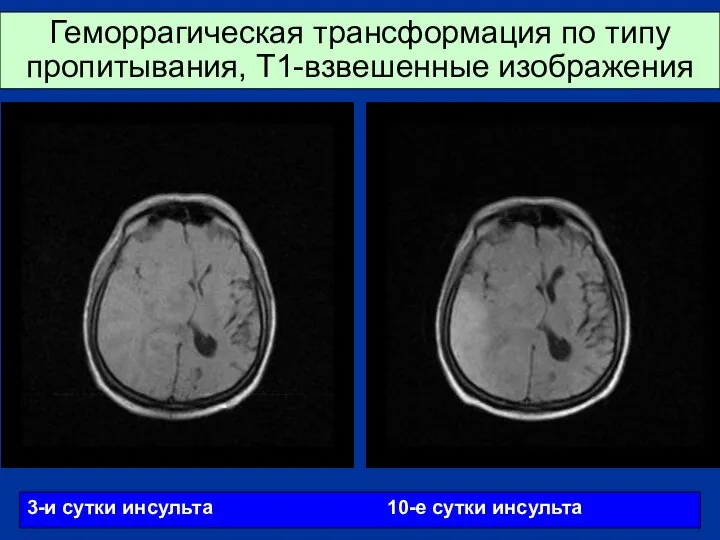 Геморрагическая трансформация по типу пропитывания, Т1-взвешенные изображения 3-и сутки инсульта 10-е сутки инсульта