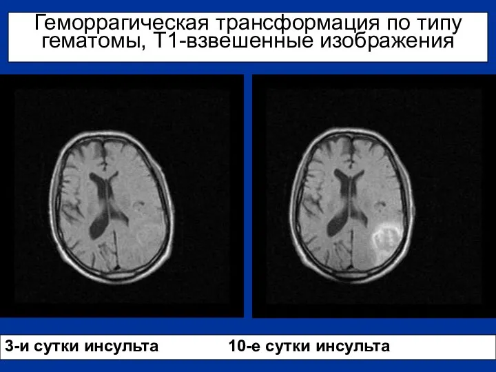 Геморрагическая трансформация по типу гематомы, Т1-взвешенные изображения 3-и сутки инсульта 10-е сутки инсульта