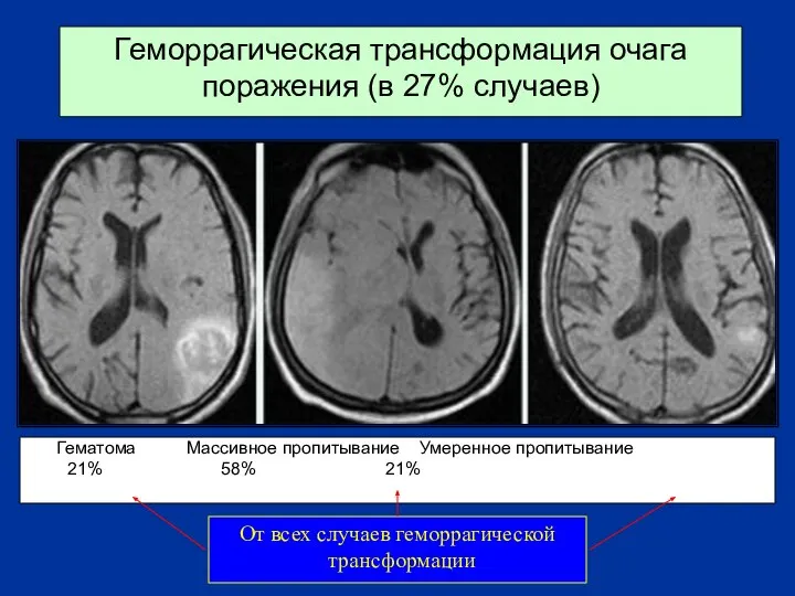 Геморрагическая трансформация очага поражения (в 27% случаев) Гематома Массивное пропитывание Умеренное